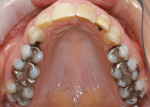 cerec before shot showing silver fillings